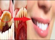 Cara Alami Membersihkan Karang Gigi Yang Membandel Dengan Cepat